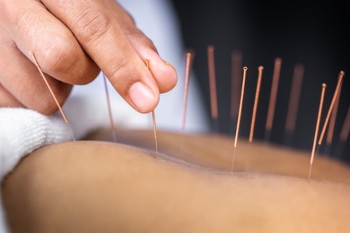 Businesses centered around acupuncture and herbalism are relocating in Southwest Austin. (Courtesy Adobe Stock)