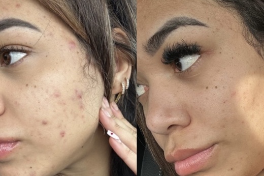 before and after photo from amazon aesthetics
